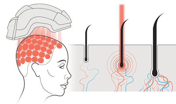 Infrared light for hair growth
